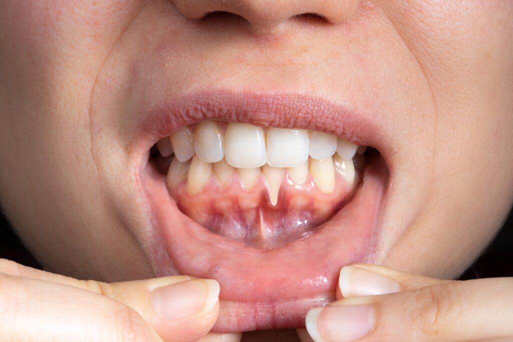 Preparing for teeth whitening with receding gums Corby